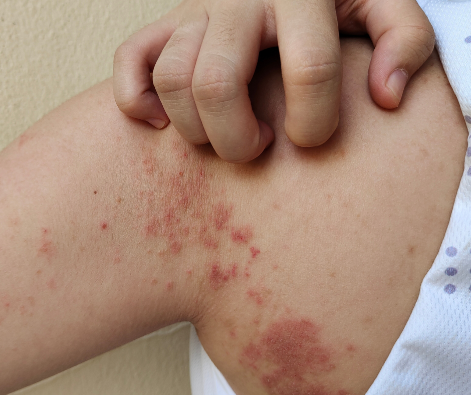 2.元凶二：塵蟎咬與過敏反應