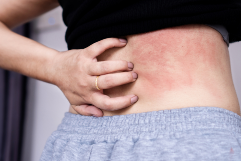 身體莫名發癢怎麼辦？塵蟎咬？夜間皮膚搔癢4大常見元凶